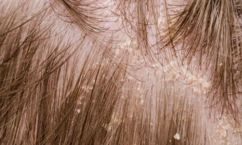 Causes and Treating Flaky, Very Dry Itchy Scalp