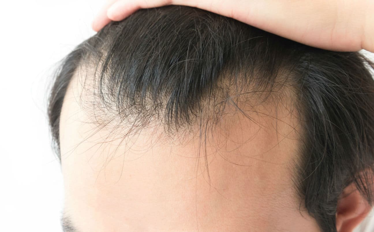 Causes of Hair Loss in Men