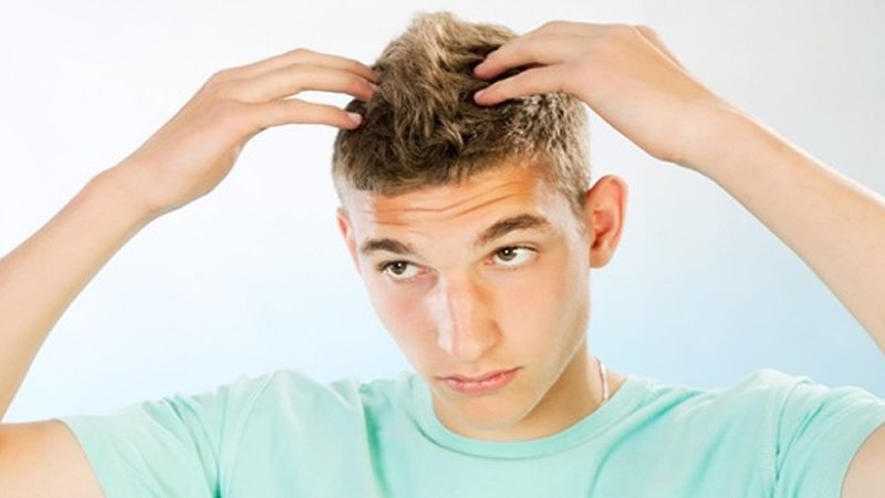 Causes of Thinning Hair in Men Younger than 30!