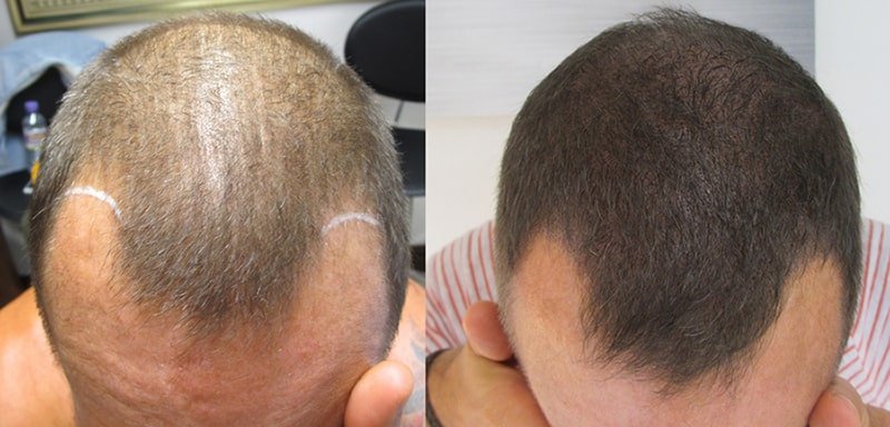 Combat Hair Loss on Men with Scalp Micropigmentation