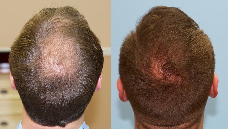 Crown Hair Loss Case Study