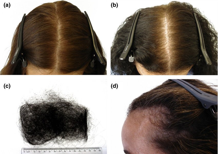 CTE: full head of hair. (b) Mild female pattern hair loss: incipient ...