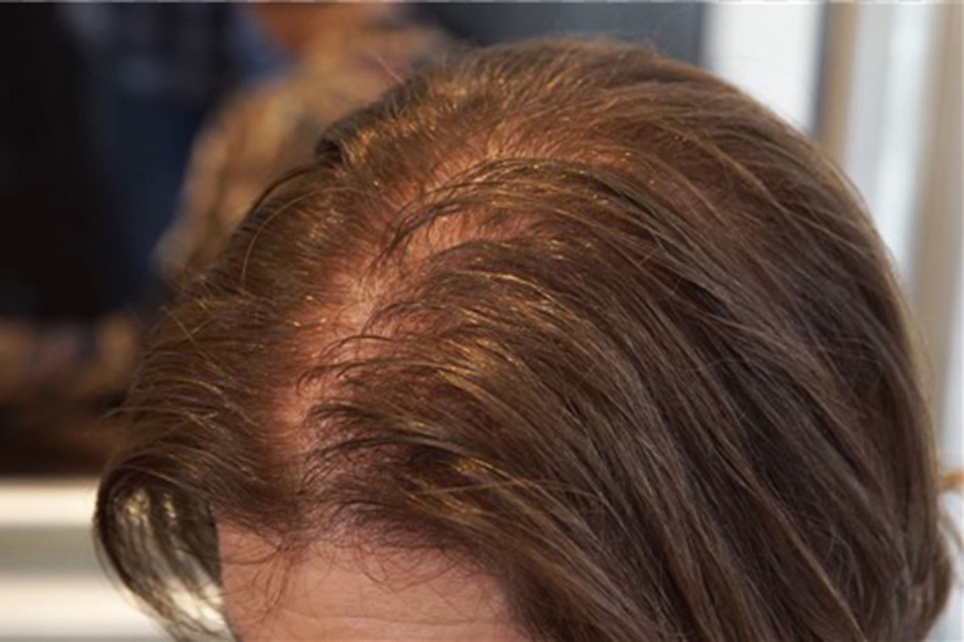cutinghairgames: My Hair Is Thinning In The Front Female