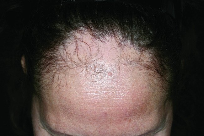Cyclosporine Hair Growth On Face