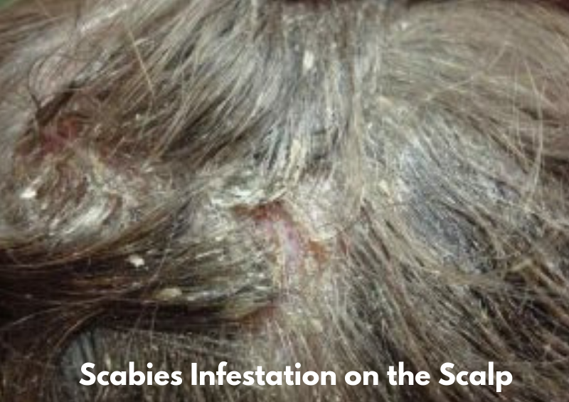 Demodex Mites On Scalp Symptoms