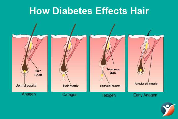 Diabetes and Hair Loss: How to Treat Hair Loss from Diabetes