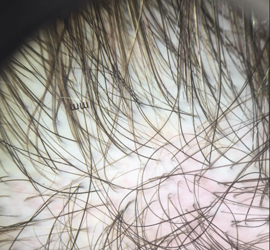 Do aromatase inhibitors cause hair loss? â Donovan Hair Clinic