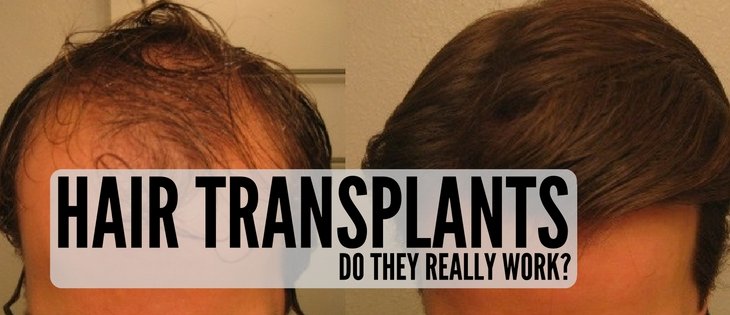 Do Hair Transplants Really Work?