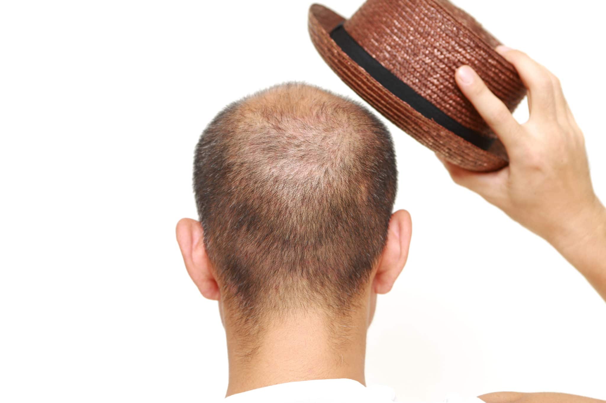 Do hats cause hair loss?