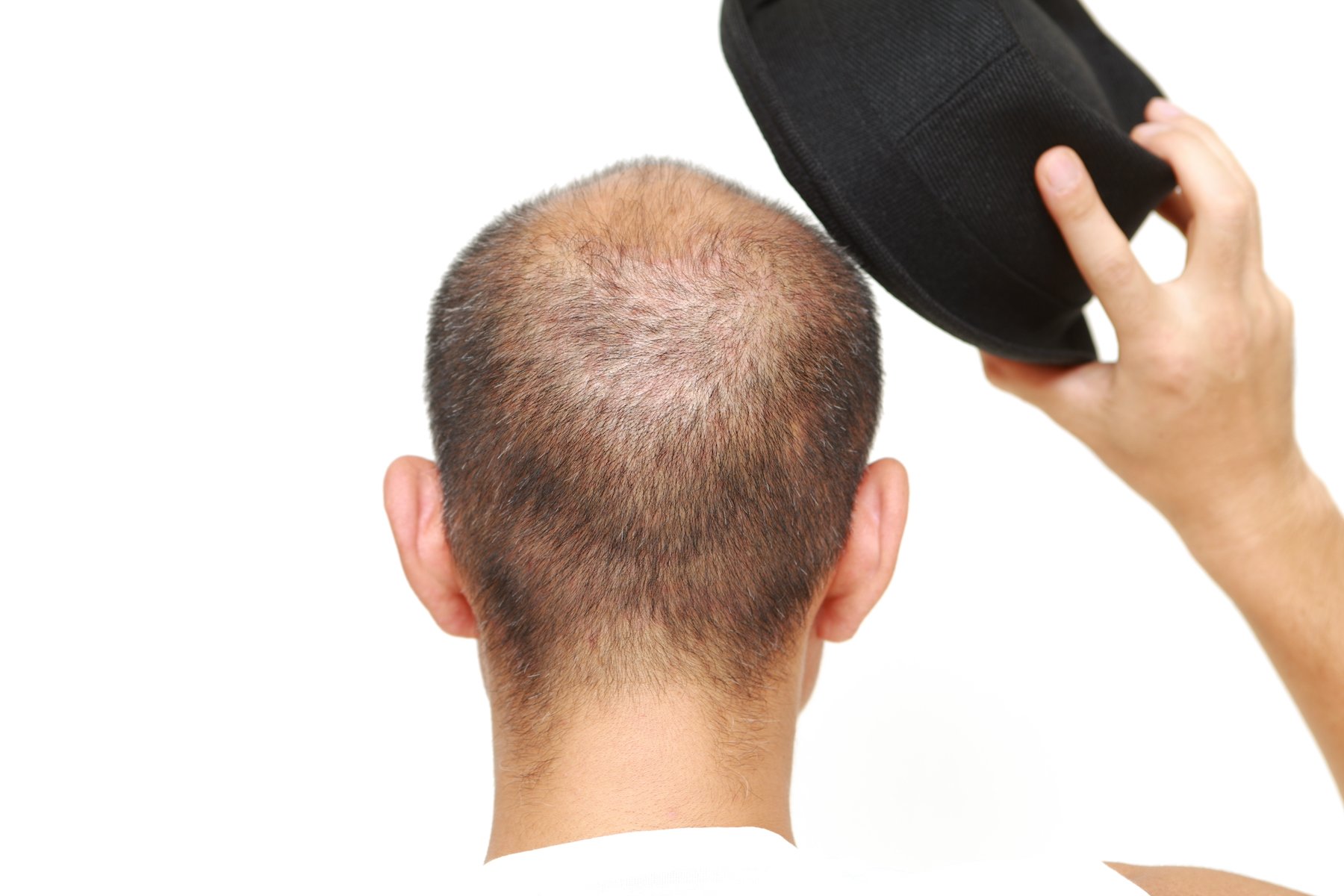 DO HATS CAUSE HAIR LOSS?