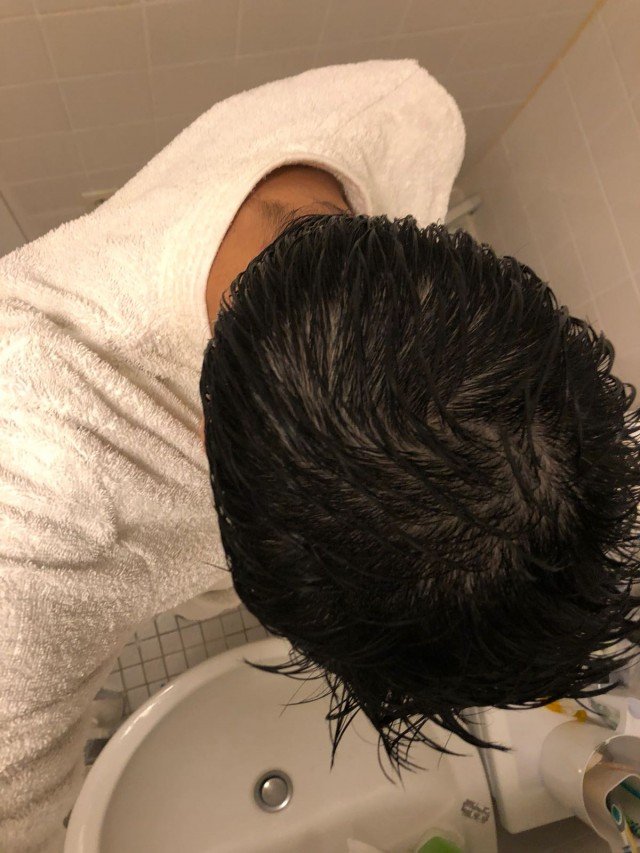 Do I Have Diffuse Hair Loss And Thinning?
