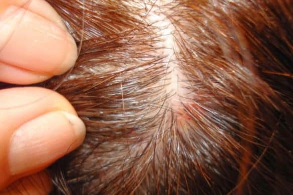Does an itchy scalp cause hair loss