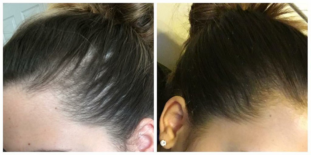 Does Hair Grow Back If You Have Alopecia?