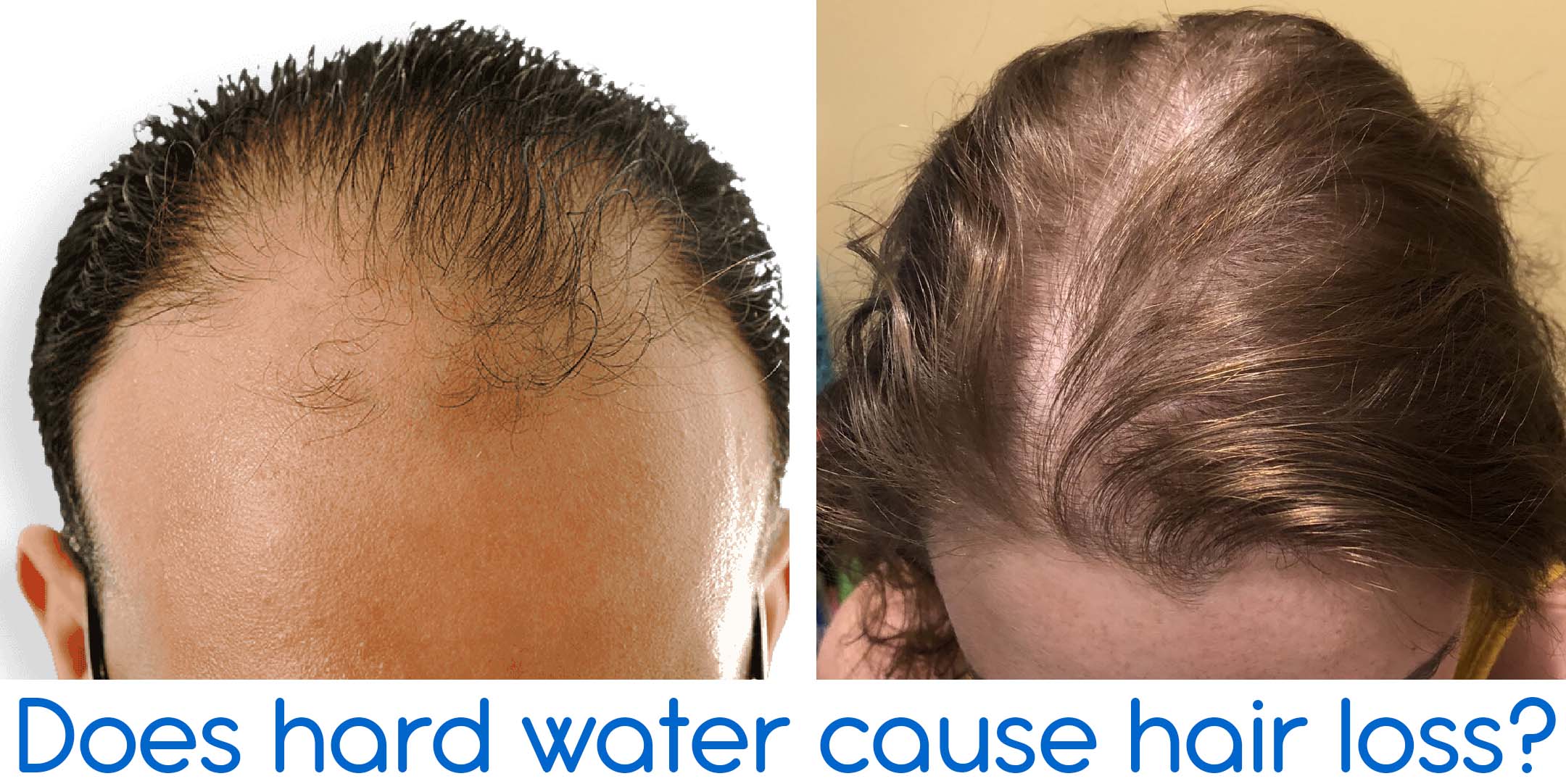 Does hard water cause hair loss?