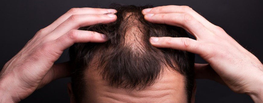 Does Humira Cause Hair Loss : Humira And Hair Loss A Phase ...