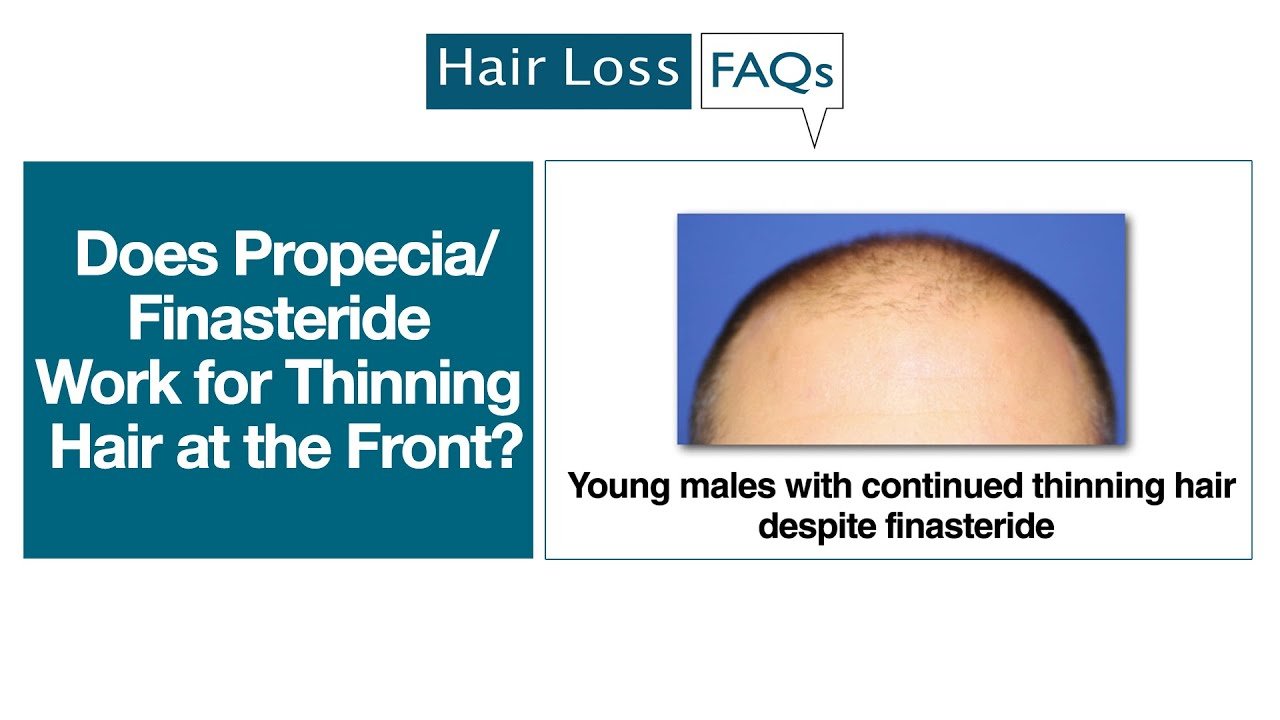Does Propecia/Finasteride Work for Thinning Hair at the ...
