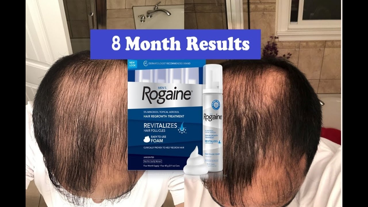 Does Rogaine REALLY Work??? 8 Month RESULTS