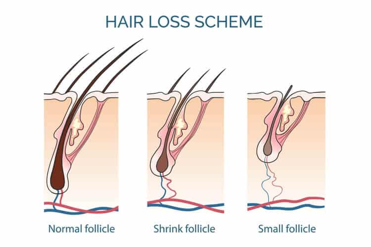 Does Rogaine Work? FDA Approved Hair Loss Treatment