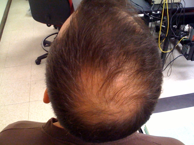 Does Vaping Cause Hair Loss - HairLossProTalk.com