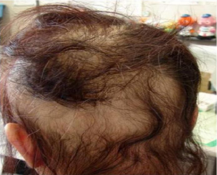 Download Can Hair Dye Cause Hair Loss Images