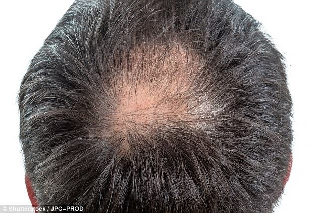 Drug designed to treat osteoporosis could be a cure for baldness
