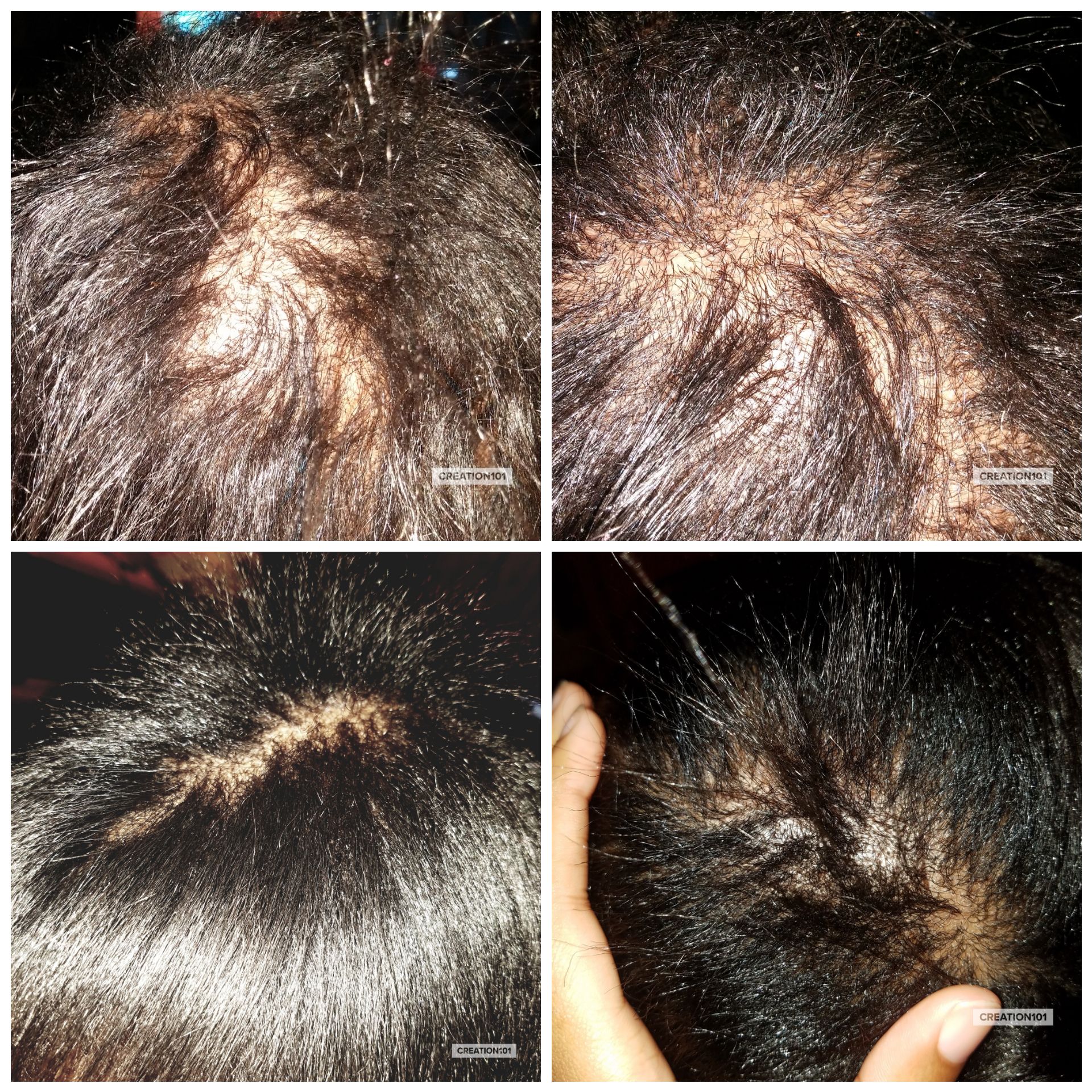 Dry Scalp Cause Hair Loss / Natural and Alternative Treatments for ...