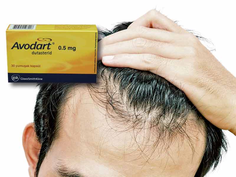 Dutasteride For Hair Loss