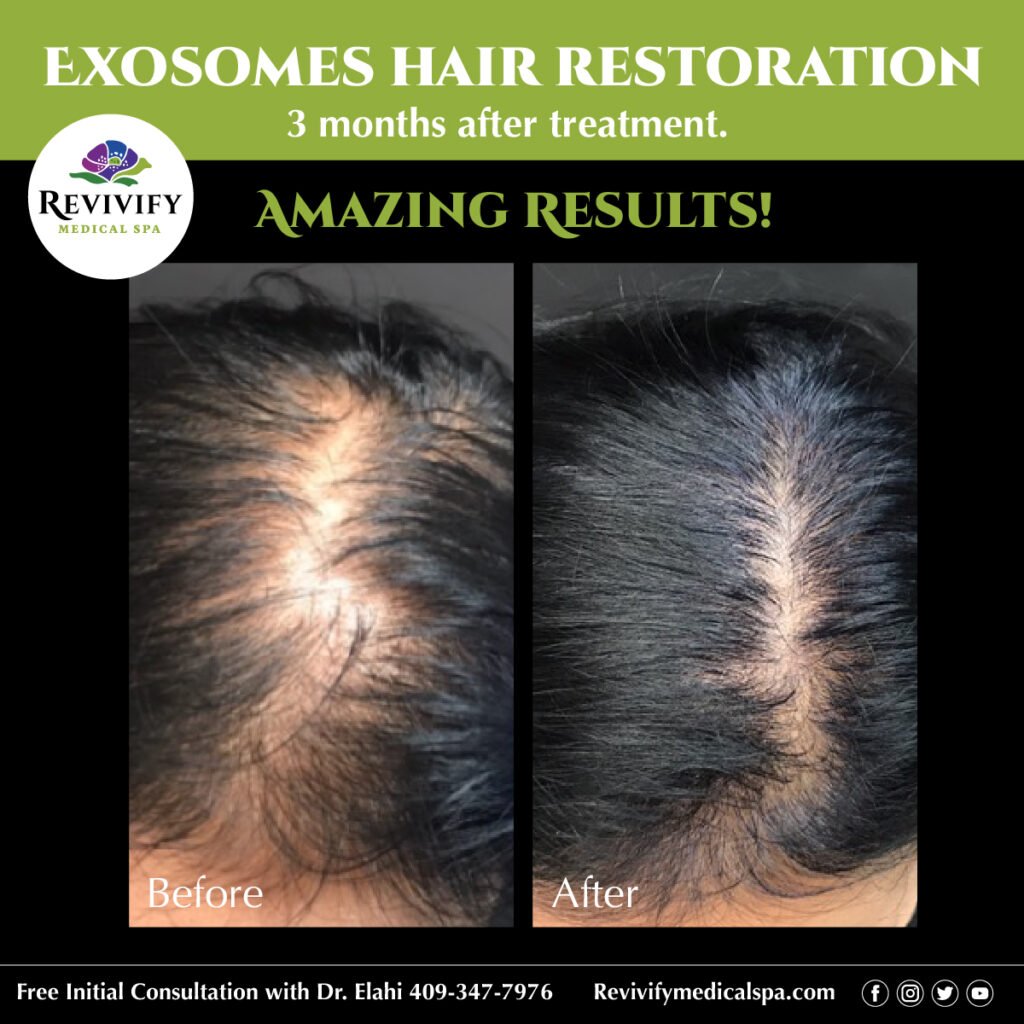 Exosomes Hair Rejuvenation