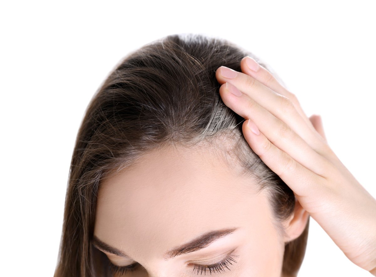 Female Hair Loss at The Temples: Causes and Treatment ...