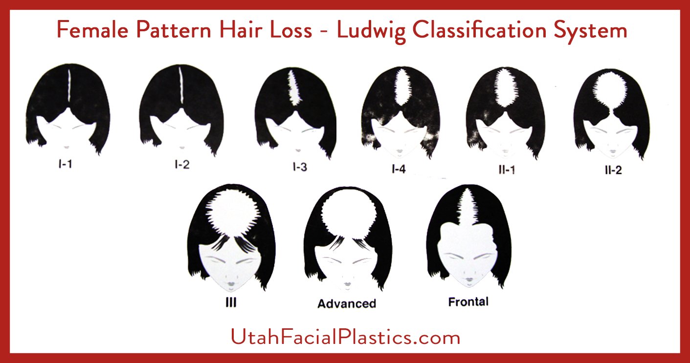 Female Patterned Hair Loss
