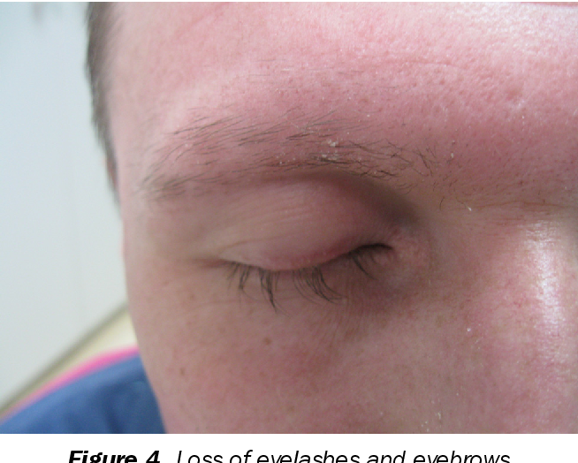 Figure 4 from Diffuse Hair Loss in Secondary Syphilis in HIV Positive ...
