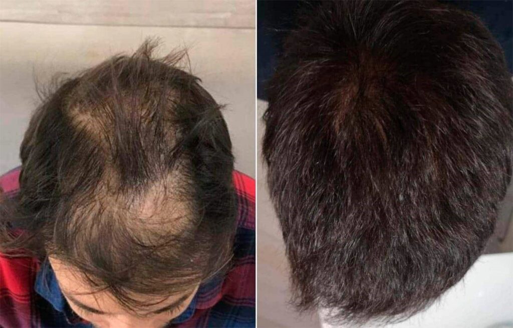 Folital Reviews  Does Dr.Robert Cyrus Hair Loss Solution Really Work ...