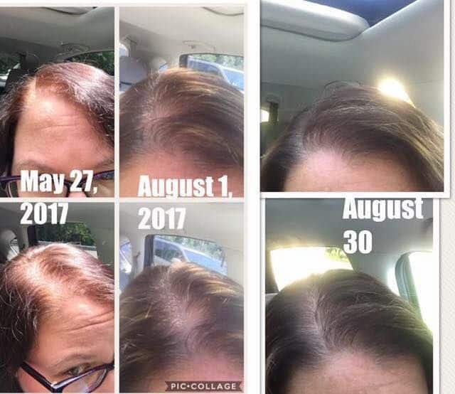 For hair loss and thinning, she alternates Revive shampoo and Black 2