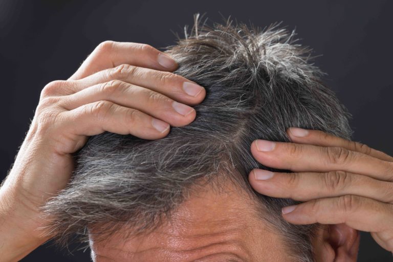 From sun to stress: what really causes hair loss?