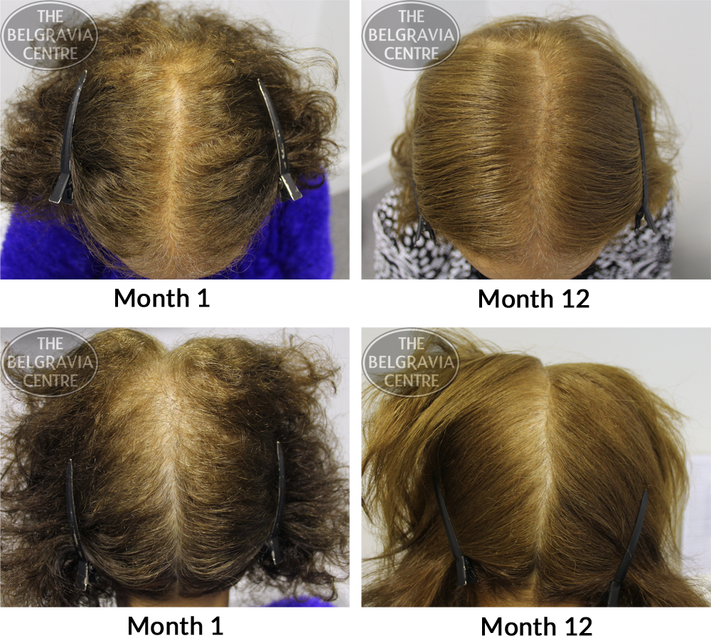 Front Hair Loss Female