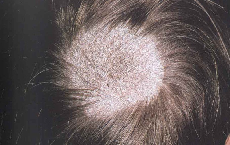Fungus Scalp Hair Loss / Do Fungus Infections Stop Hair ...