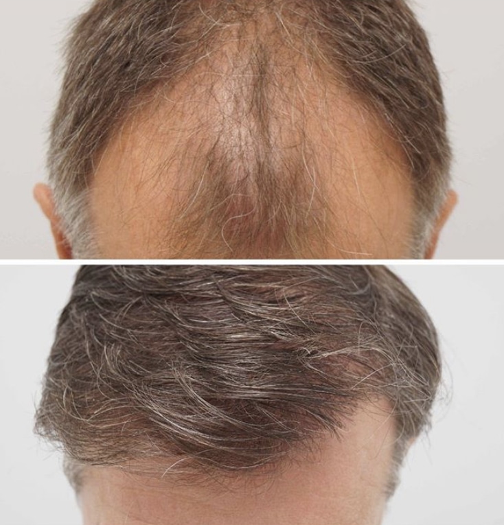 Glass speaks to Dr Greg Williams  hair loss and hair transplant ...