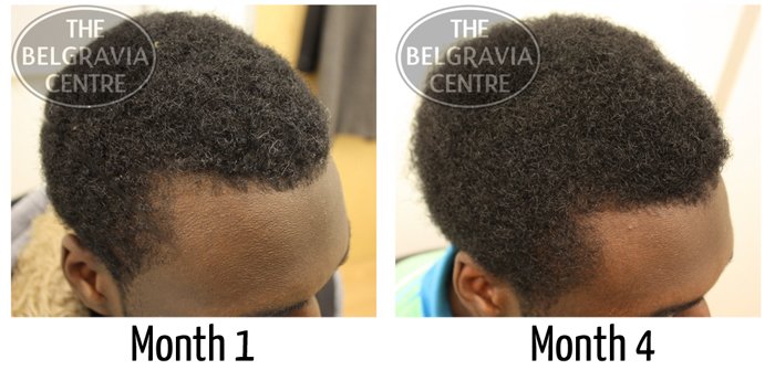 Hair Growth Products For Black Men
