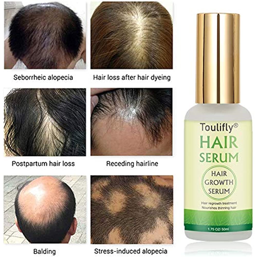 Hair Growth Serum, Loss And Thinning Treatment, Stops Loss, Natural ...