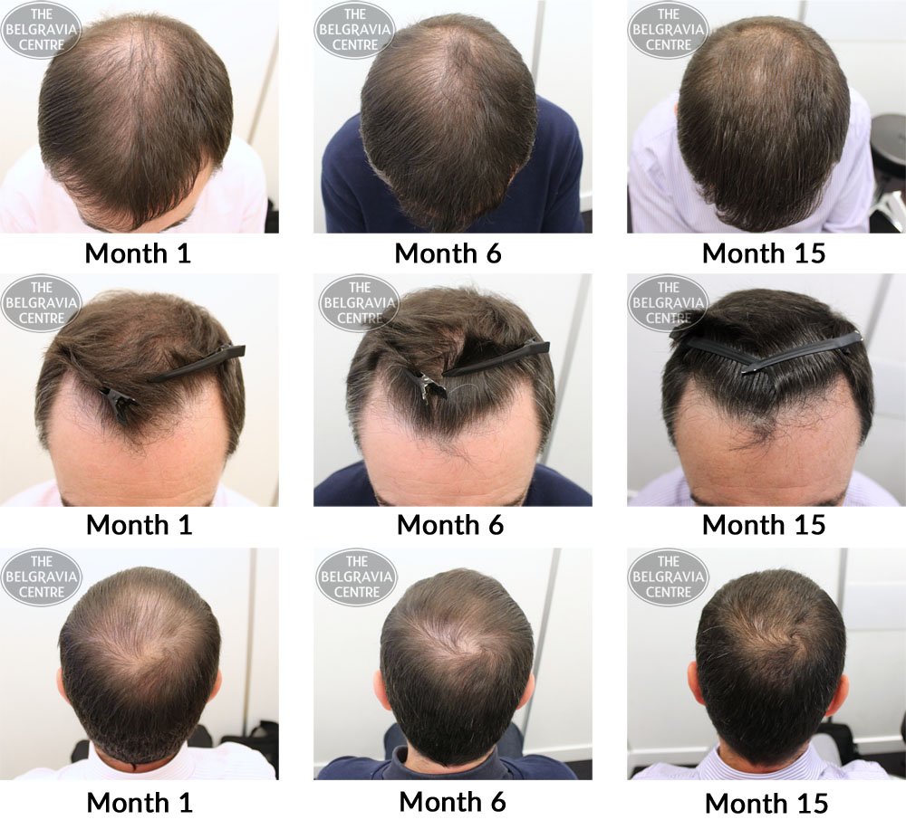 Hair Growth Success: âthere has been significant regrowthâ?