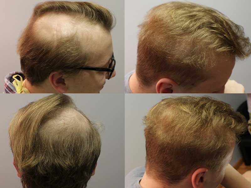 Hair Loss After Surgery: How To Grow Your Hair Back?