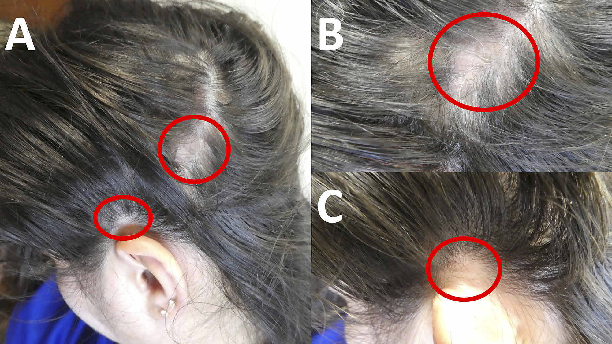 Hair Loss And Arthritis / Hair Loss Symptoms And Causes Mayo Clinic ...