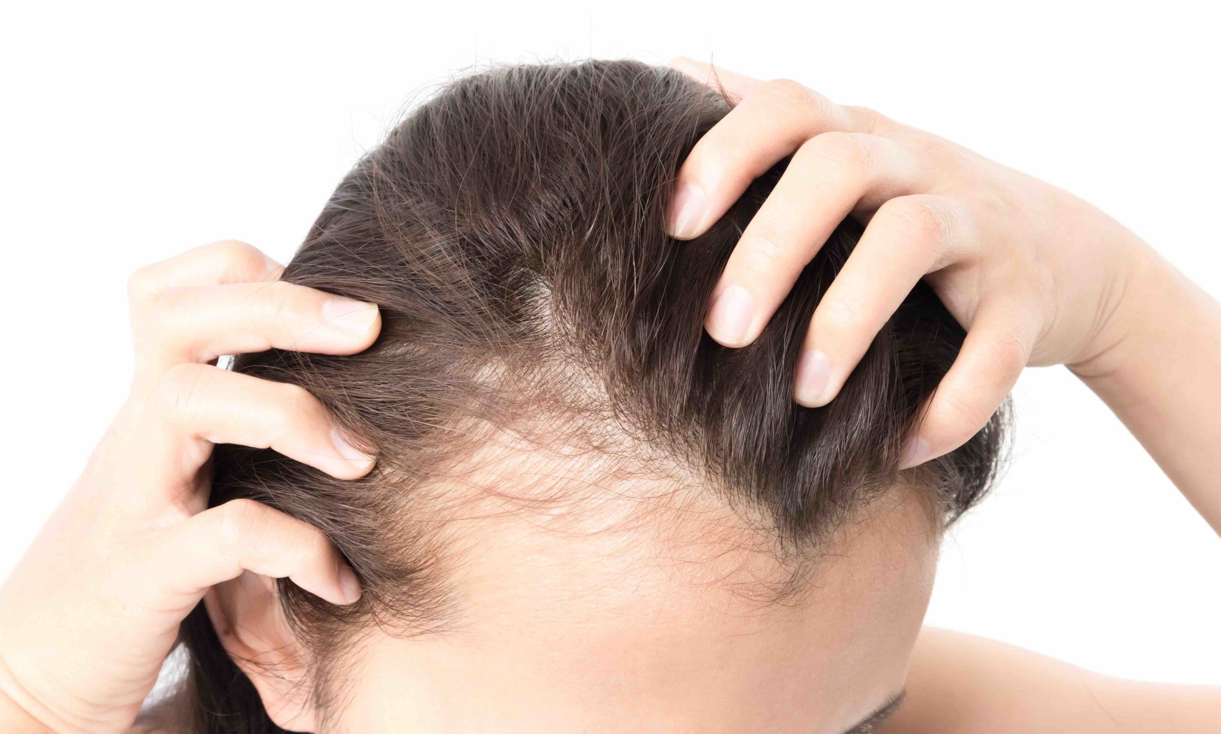 Hair Loss and Hormonal Imbalance in Women