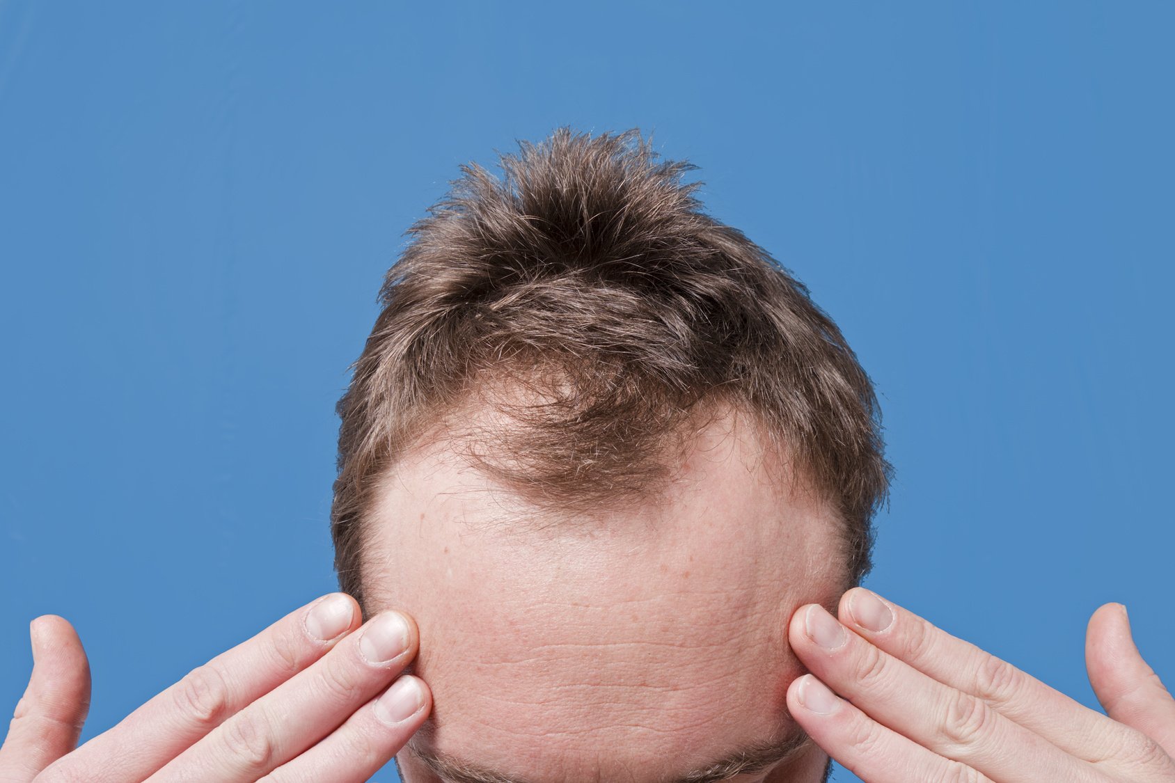 Hair Loss and Male Pattern Baldness (Androgenetic Alopecia ...