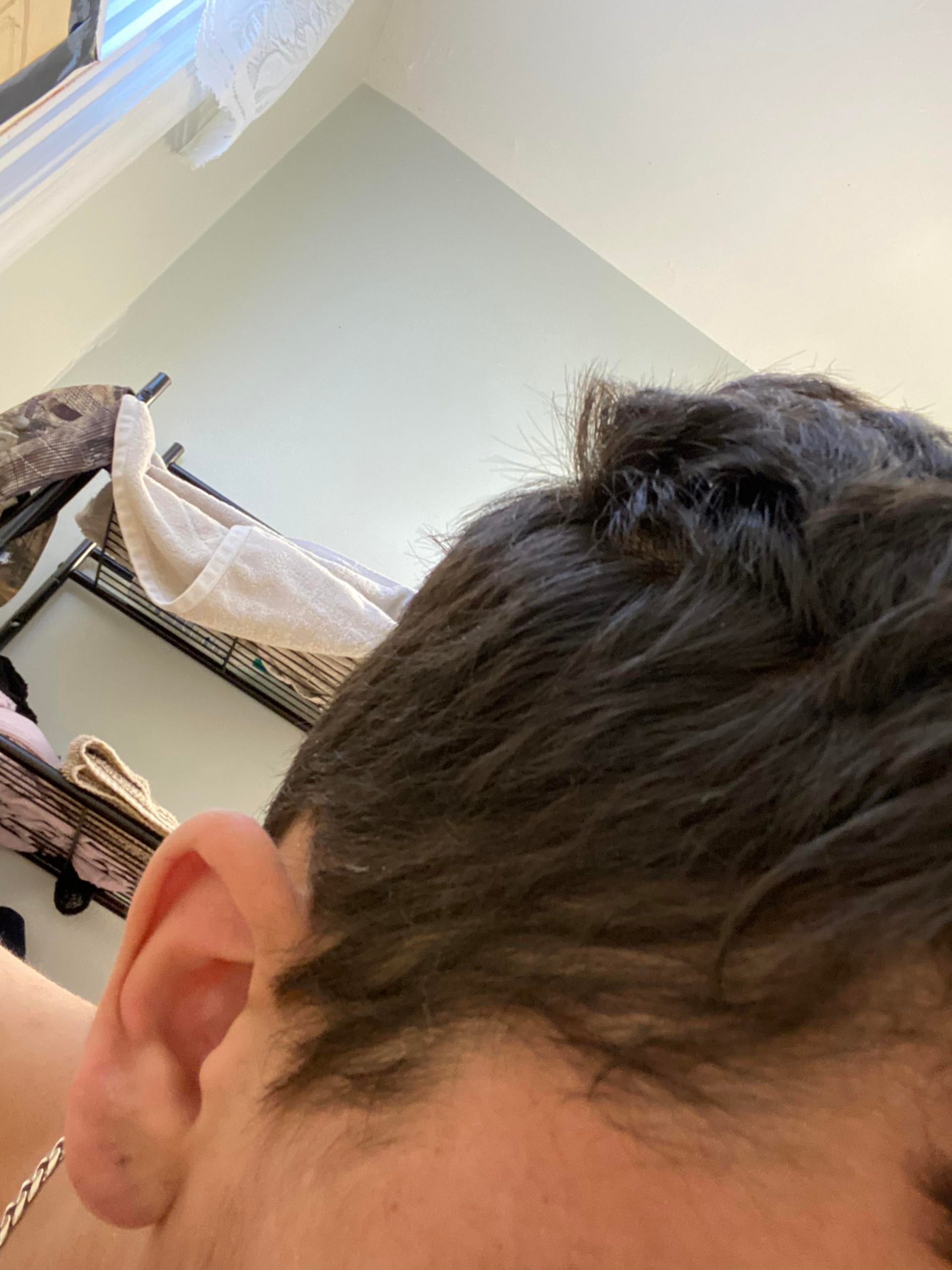 Hair loss and thinning on side of my head!! Is this temporary? Never ...