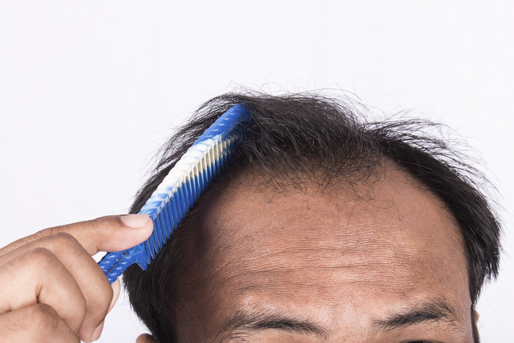 Hair Loss Causes in Men: Learn the Facts