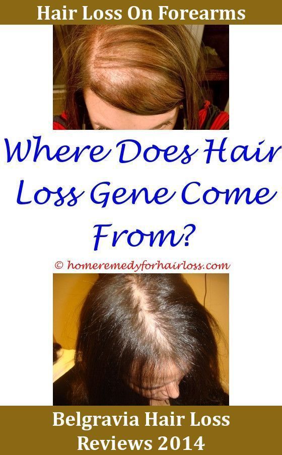 Hair Loss Coffee And Hair Loss,Hair Loss do beanies cause ...