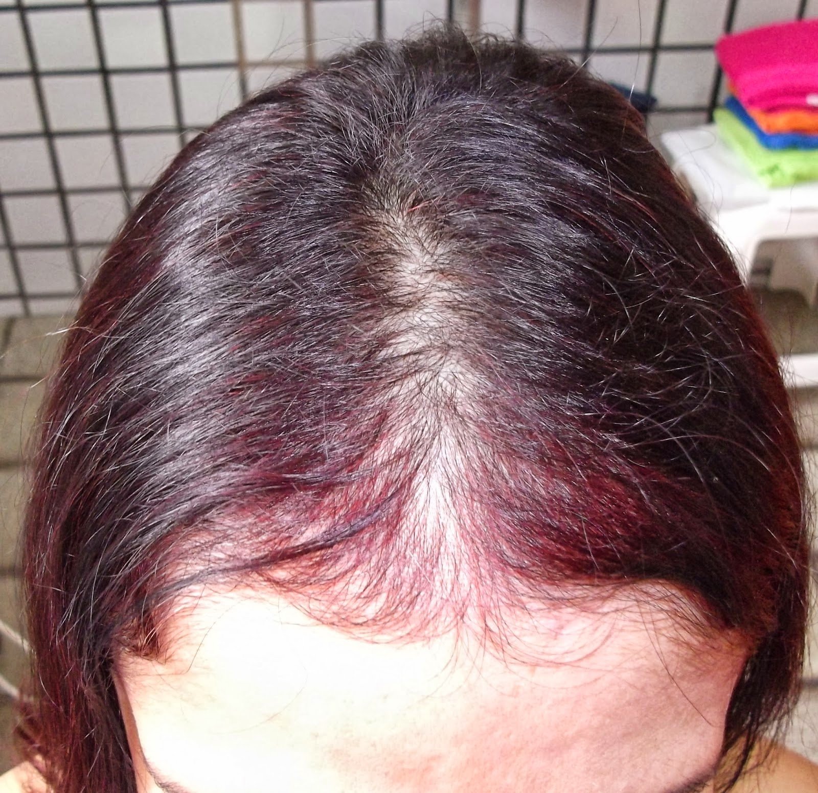 hair loss doctor: What is telogen effluvium