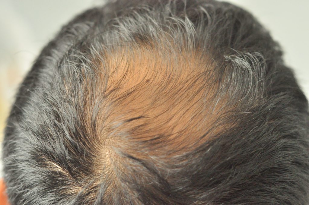 Hair Loss Frequently Asked Questions