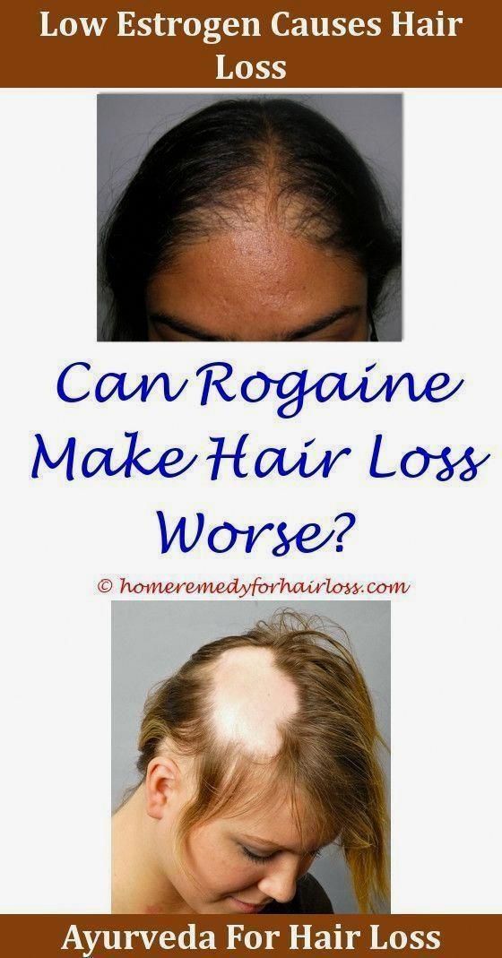 Hair Loss Go Away Please #HairLossGoAwayPlease